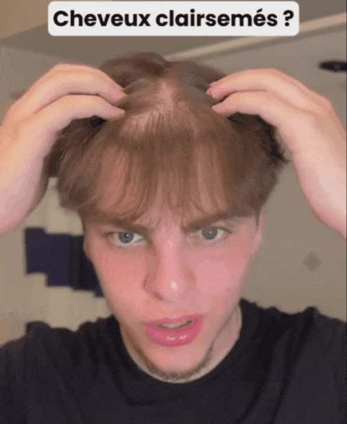 RENAISSANCE- L’Essence Anti-Calvitie